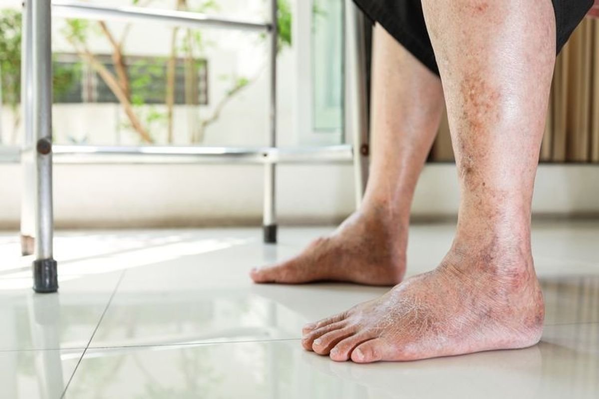 Diabetic Foot Bisa Berujung Amputasi