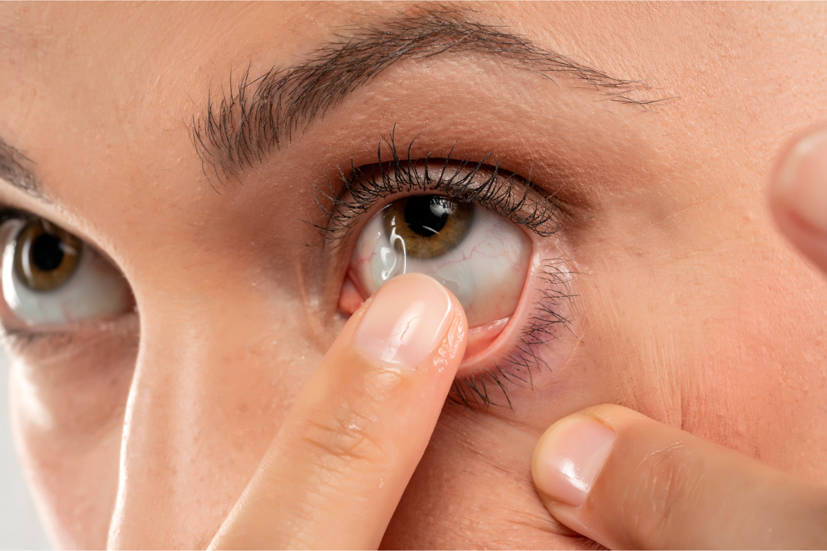 Video Viral Softlens Tersangkut di Kelopak Mata